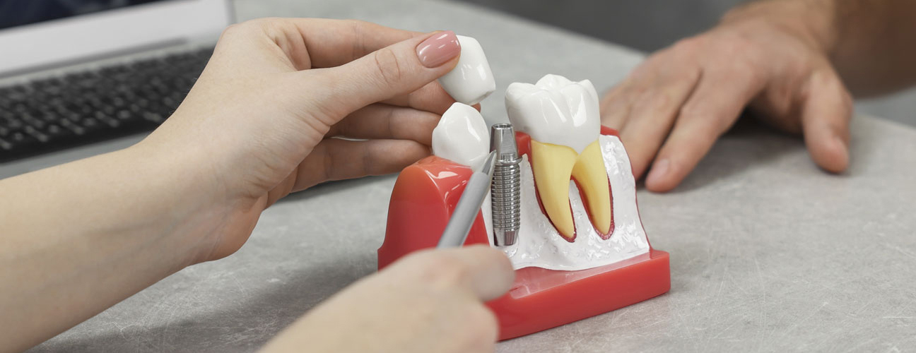 Dental implants